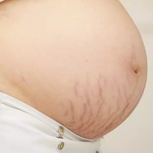 Postnatal obesity